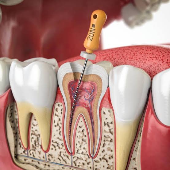 Endodoncia y Periodoncia en Moratalaz, Clínica Dental Balleros