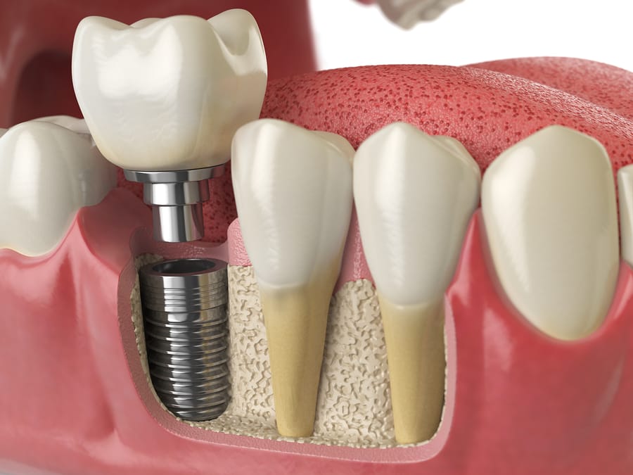 Implantología Dental en Moratalaz, Clínica Dental Balleros