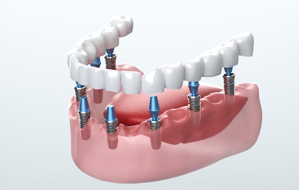 Prostodoncia en Moratalaz, Clínica Dental Balleros