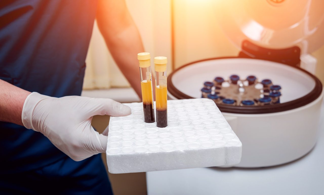 PRP, Plasma Rico en Plaquetas, en Moratalaz, Clínica Dental Balleros